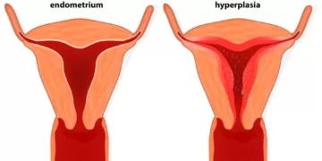ენდომეტრიოზი | ფოტო