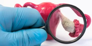 საკვერცხის კიბო, სიმსივნე | ფოტო