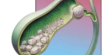 ნაღვლის ბუშტის კენჭები | ფოტო