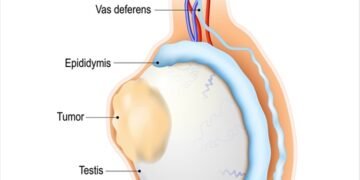 სათესლე ჯირკვლის კიბო