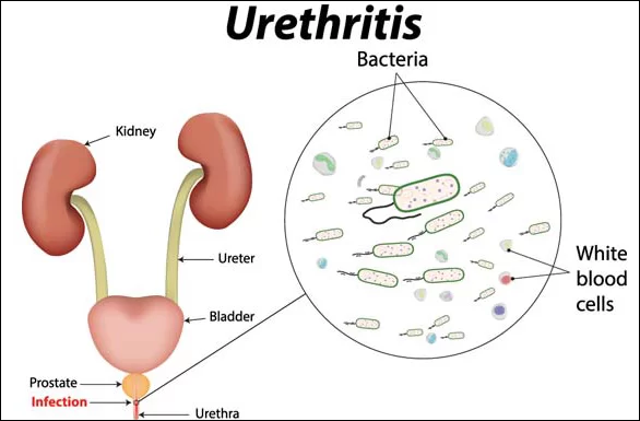 Urethritis, illustration | photo