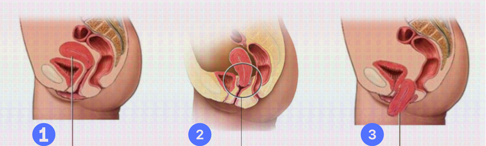 Uterine prolapse | Photo