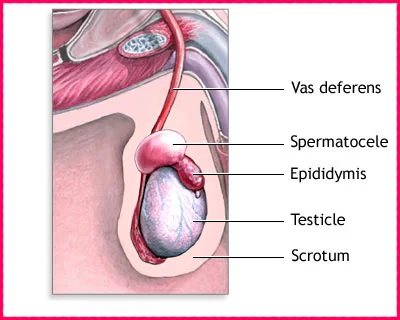 Сперматоцеле - иллюстрация
